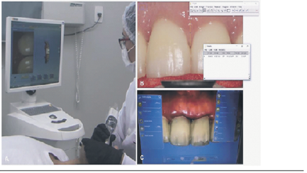 Intra oral scanning with OMNICAM Sirona camera (Dentsply Sirona CAD / CAM - CEREC Omnicam Dental CAD / CAM System, York, United States) (B) obtaining the measure and (C) 3D evaluation of the case.