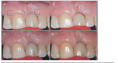 Images obtained with aid of photographic device for (A) T0 = Initial; (B) T1 = immediately after application; (C) T2 = 1 month after the application and (D) T3 = 2 months after the application.