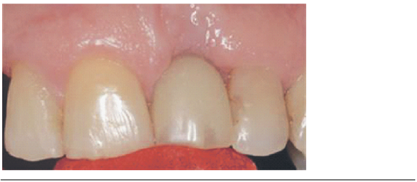 Final image 3 months after the application (T4).