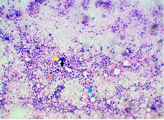 Linfoma No Hodgkin. Linfoma No
Hodgkin. Se evidencia una población monomorfa de células linfoides de tamaño
mediano. Se observa células con núcleos agrandados (flecha anaranjada), hipercromasia (flecha amarilla), núcleos irregulares y atípicos (flecha azul), y amoldamiento nuclear (flecha negra). (Hematoxilina y Eosina;
10x).