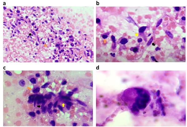 Osteosarcoma. 2a. Se observan
células ahusadas (flecha negra) y de
aspecto plasmocitoides (flecha
anaranjada) con atipias tales como nucleomegalia, irregularidad nuclear e
hipercromasia (H-E; 10x). 2b y 2c Se
observan células plasmocitoides y ahusadas, con marcada hipercromasia (flecha negra) e irregularidad nuclear (flecha anaranjada), presencia de una
matriz de aspector osteoide entremezclado con las células (flecha amarilla), y 2d. Se
observa célula multinucleada (H-E; 40x)