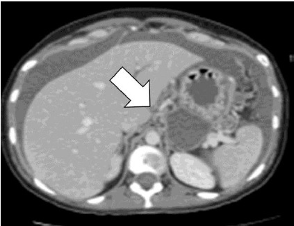 Tomografía axial
computada abdominal sin contraste. La flecha indica la tumoración gástrica
acompañada de engrosamiento del resto de la pared gastrica y ascitis
importante. 



 
