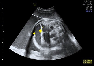 Asas
yeyuno-ileales dilatadas de 18 mm que sugieren una obstrucción intestinal
yeyuno-ileal a las 33+2 semanas.