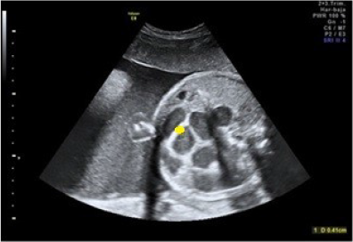 Paredes intestinales
a nivel yeyuno-ileal hiperrefringentes y edematosas de 4 mm de grosor a las
33+2 semanas.