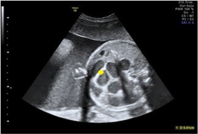 A las 36
semanas progresión de la obstrucción de asas yeyuno-ileales con una dilatación
de 26 mm con contenido meconial visible. Aumento del edema de la pared
intestinal de asas yeyuno-ileales a 5 mm de grosor.