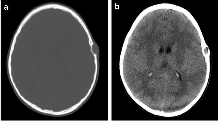 Tomografía Computarizada cerebral. 1a. ventana
ósea. Se observa LOE, hipodensa, extradural
ovoidea, de característica lítica en región parietal izquierda con un diámetro
aproximado de 8,8x17mm. 1b. ventana parenquimatosa. No se observan
alteraciones.