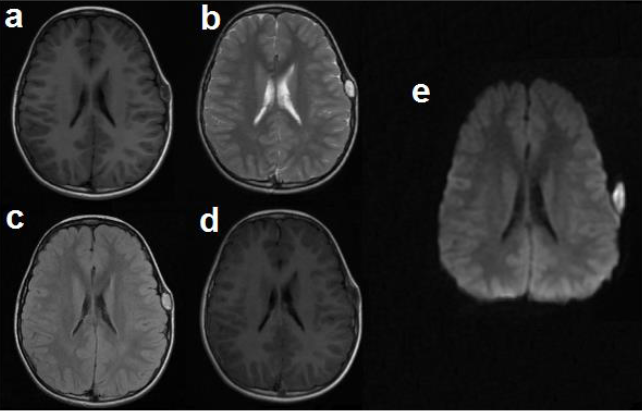 Resonancia magnética cerebral contrastada. Se
observa imagen extradural, de forma ovoidea, bien
delimitada con bordes regulares de características quísticas en región parietal
izquierda, de comportamiento heterogéneo 2a. hipo e isointensa
en secuencia T1. 2b. hiperintensa en T2. 2c. FLAIR.
2d. sin captación tras la administración de contraste 2e. restricción
en difusión.