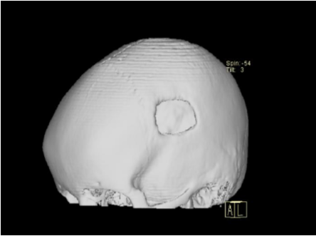 Defecto óseo en hueso parietal izquierdo en
reconstrucción 3D postquirúrgica.