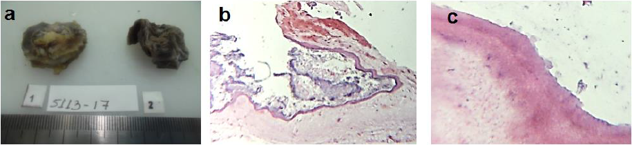 Hallazgos Anatomopatológicos.
4a. Muestra para análisis histopatológico de la lesión posterior a la excéresis total de la misma. 4b. Se observa hueso
citológicamente insignificante con un espacio quístico lleno de queratina
revestido por un epitelio escamoso con una capa granular íntegra. (Tinción con
hematoxilina-eosina). 4c. Espacio quístico lleno de queratina revestido por
epitelio escamoso. (Tinción con hematoxolina-eosina).