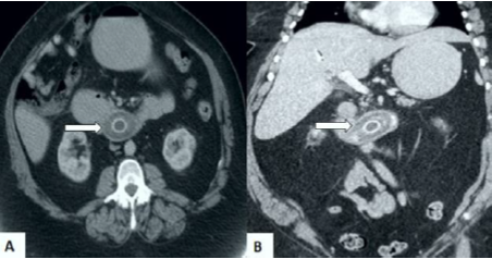 Tomograf&iacute;a computada abdominop&eacute;lvica. A) Imagen axial que demuestra c&aacute;lculo biliar (flecha) en la tercera porci&oacute;n del duodeno con el duodeno proximal y el est&oacute;mago lleno de l&iacute;quido. B) Imagen coronal que muestra el c&aacute;lculo biliar en la tercera porci&oacute;n del duodeno (flecha), neumobilia y dilataci&oacute;n del est&oacute;mago.