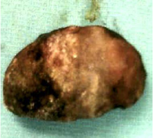 C&aacute;lculo biliar de 9 cent&iacute;metros de largo removido durante la cirug&iacute;a.