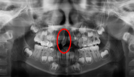 Radiografa panormica mostrando la presencia de un mesiodens.