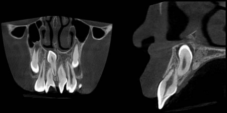 Aspecto del mesiodens en una tomografa conebeam. Se aprecia mejor la relacin con las estructuras anatmicas circundantes.