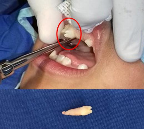 Aspecto macroscpico de un mesiodens despus de la extraccin.