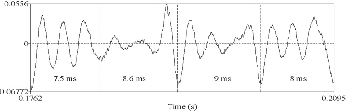 Irregularidad de cuatro pulsos glotales durante fonaci&oacute;n laringalizada