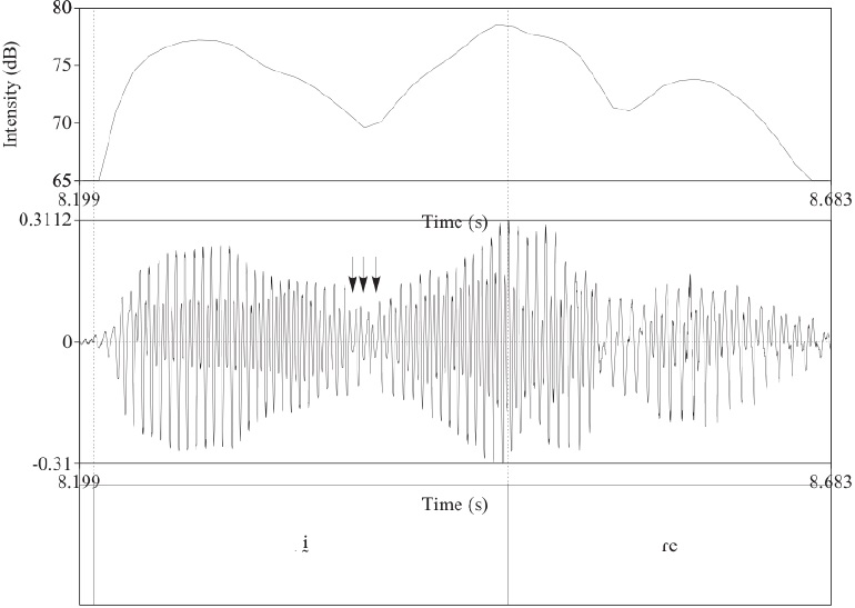 La laringalizaci&oacute;n ocurre en el medio de la vocal
