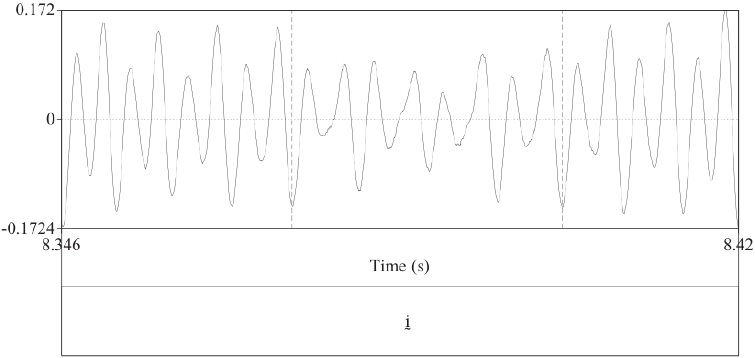 Laringalizaci&oacute;n con vibraciones peri&oacute;dicas