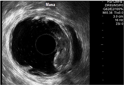 Tumor de
recto que se sale de la capa V endosonogr&aacute;fica y compromete tejido perirrectal