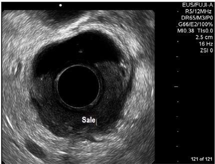 Tumor
maligno de recto que se sale de la capa V endosonogr&aacute;fica, compromete tejido
perirrectal y se asocia con adenopat&iacute;a de aspecto tumoral maligno perif&eacute;rica