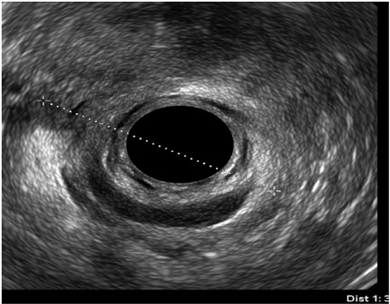 Canal anal
medio con defecto y ausencia de esf&iacute;nteres en media circunferencia anterior, 1800