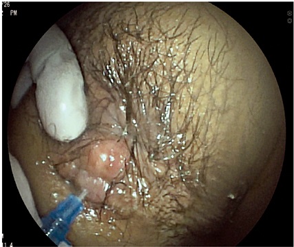 Orificio
secundario de f&iacute;stula perianal canalizado con intracat para inyecci&oacute;n de agua oxigenada