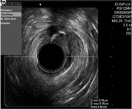 F&iacute;stula
transesfint&eacute;rica enre canal anal medio e inferior, dibujando trayecto con
inyecci&oacute;n de agua oxigenada