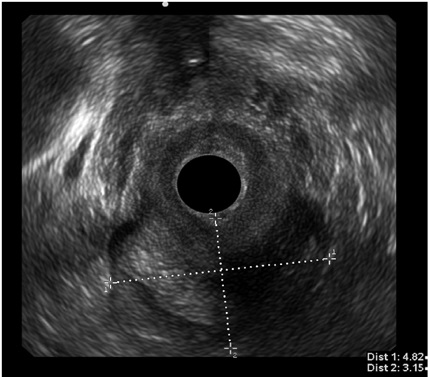 Gran
absceso isquiorrectal con componente en herradura