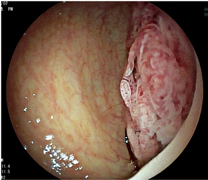 Adenoma
velloso de recto inferior