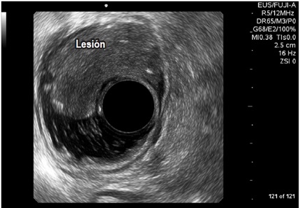 Adenoma
velloso de recto inferior, compromiso hasta capa III (submucosa) y posibilidad
de resecci&oacute;n endosc&oacute;pica