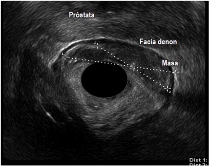Tumor
maligno de recto inferior que compromete la musculatura propia sin sobrepasar T2