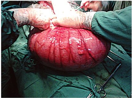 Aspecto del
colon durante la terminaci&oacute;n de la intervenci&oacute;n quir&uacute;rgica