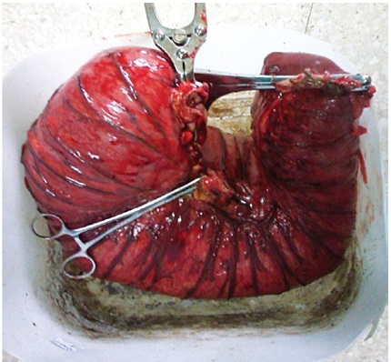 Pieza
quir&uacute;rgica disecada de 60 cm x 25 cm x 15 cm.