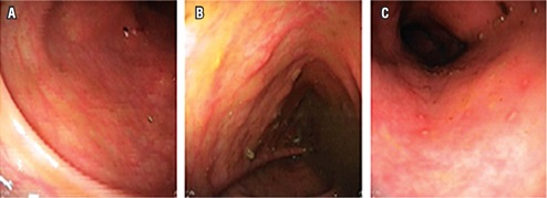 Im&aacute;genes de la colonoscopia. A. Mucosa eritematosa
en parches sin ulceraciones ni f&iacute;stulas. B y C. Mucosa derecto sigmoide con
microabscesos con halo eritematoso. Diagn&oacute;stico: proctocolitis con
microabscesos