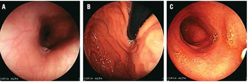 Im&aacute;genes de
endoscopia digestiva alta. A. Es&oacute;fago normal. B. Mucosa de fondo g&aacute;strico
normal. C. Mucosa con eritema difusa y de aspecto
nodular. Diagn&oacute;stico: duodenitis nodular.