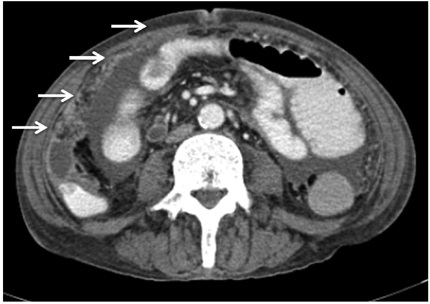 TC de abdomen. Nodularidad del epipl&oacute;n en toda su extensi&oacute;n, con formaci&oacute;n de peque&ntilde;a colecci&oacute;n hacia fascia lateroconal