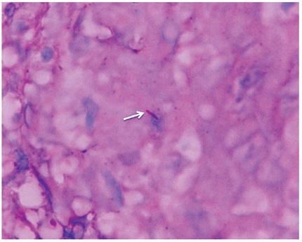 Biopsia peritoneo. Tinci&oacute;n de Ziehl-Neelsen de tejido lesionar con evidencia de bacilos &aacute;cido alcohol resistentes. Cortes&iacute;a de: Hugo Herrera, M&eacute;dico Pat&oacute;logo FCI.