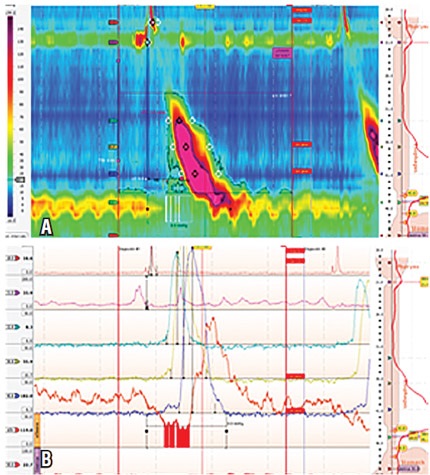 Paciente masculino de 63 a&ntilde;os con ICD de 8351 mm Hg/cm/s con onda de gran
amplitud y relajaci&oacute;n completa del esf&iacute;nter esof&aacute;gico inferior. A) Manometr&iacute;a
de alta resoluci&oacute;n. B) Manometr&iacute;a convencional.