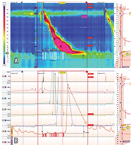 Paciente femenina de 45 a&ntilde;os con ICD de 12562 mm Hg/cm/s con onda de gran
amplitud y velocidad. A) Manometr&iacute;a de alta resoluci&oacute;n. B) Manometr&iacute;a convencional.