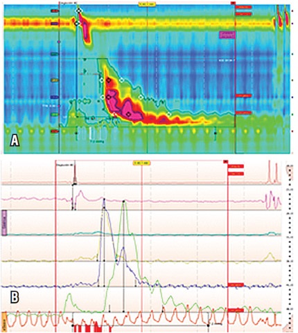 Paciente masculino de 72 a&ntilde;os con ICD de 8809 mm Hg/cm/s con onda multipico (por lo menos tres picos), de gran amplitud y
duraci&oacute;n. A) Manometr&iacute;a de alta resoluci&oacute;n. B) Manometr&iacute;a convencional.