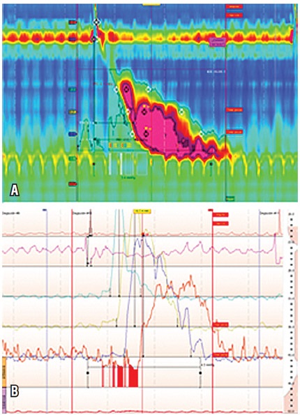 Paciente masculino con ICD de 16285 mm Hg/cm/s. con onda multipico
que presenta gran amplitud y velocidad, con relajaci&oacute;n completa del esf&iacute;nter
esof&aacute;gico inferior A) Manometr&iacute;a de alta resoluci&oacute;n. B) Manometr&iacute;a convencional.