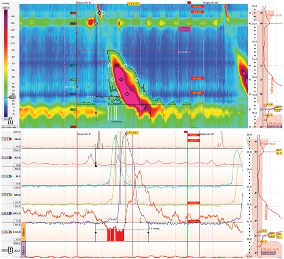 Paciente femenina de 41 a&ntilde;os con ICD de 8258 mm Hg/cm/s. A) Manometr&iacute;a de alta
resoluci&oacute;n. B) Manometr&iacute;a convencional.