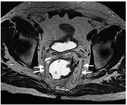 Resonancia magn&eacute;tica secuencia axial con informaci&oacute;n T2. Se aprecia la
disposici&oacute;n normal de la fascia mesorrectal en ambos
lados de la pelvis (flechas blancas) en un paciente con un engrosamiento y una
irregularidad de la pared lateral izquierda del recto por un c&aacute;ncer colorrectal
estadio T2 (flechas negras).