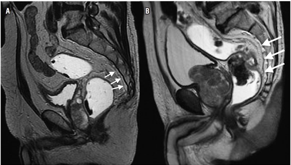 (A) y (B) Resonancia magn&eacute;tica secuencia sagital con informaci&oacute;n T2. Se
aprecia la disposici&oacute;n normal de la fascia presacra (flechas blancas).