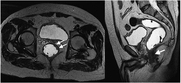 Resonancia magn&eacute;tica secuencia axial con informaci&oacute;n T2 axial. Se identifica
una masa en la pared anterior del recto entre las 12 y las 4 horas, a 7 cm del
reborde anal, de aproximadamente 40 mm de longitud y 7 mm de espesor, que se
extiende hasta la muscular, compatible con un c&aacute;ncer estadio T2.