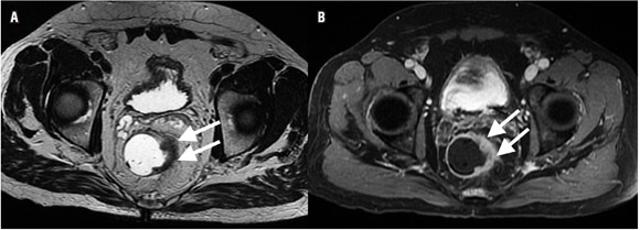 (A) Resonancia magn&eacute;tica secuencia axial con informaci&oacute;n T2 y (B) resonancia
magn&eacute;tica secuencia axial con informaci&oacute;n T1 posterior a la administraci&oacute;n de
medio de contraste. A 7 cm del reborde anal se identifica una masa en la pared
lateral izquierda del recto (flechas blancas) entre la 1 y las 6 horas, de 36
mm de longitud y 9 mm de espesor, transmural, con un componente de 7 mm que
infiltra la grasa mesorrectal entre la 1 y las 3 horas, a 21 mm de la fascia mesorrectal. Hay realce heterog&eacute;neo posterior a la
administraci&oacute;n del medio de contraste intravenoso.