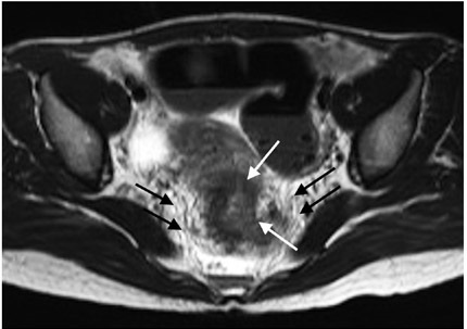 Resonancia magn&eacute;tica secuencia axial con informaci&oacute;n T2. Se identifica masa
que ocupa la totalidad de la circunferencia del recto (flechas blancas), con
alteraci&oacute;n de la grasa y compromiso de la fascia
mesorrectal (flechas negras) por extensi&oacute;n tumoral, asociado con ulceraci&oacute;n
tumoral, hallazgo relacionado con tumor colorrectal estadio T3a.
