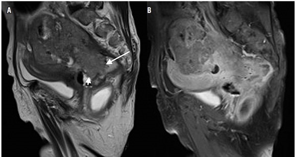 (A) Resonancia magn&eacute;tica secuencia sagital con informaci&oacute;n T2 y (B)
secuencia sagital con informaci&oacute;n T1 posterior a la administraci&oacute;n intravenosa
de medio de contraste. Masa heterog&eacute;nea que compromete la pared del recto
(flecha blanca larga), la c&uacute;pula vaginal (flecha blanca corta) y la pared
posterior del &uacute;tero con crecimiento hacia la cavidad abdominal, la cual
presenta realce heterog&eacute;neo con el medio de contraste.