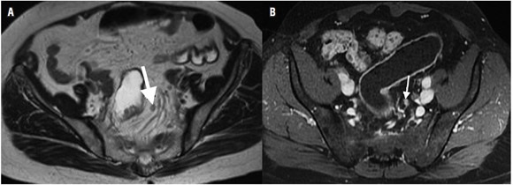 (A) Resonancia magn&eacute;tica secuencia sagital con informaci&oacute;n T2 y (B)
secuencia sagital con informaci&oacute;n T1 posterior a la administraci&oacute;n intravenosa
de medio de contraste. Se identifica un ganglio linf&aacute;tico, redondeado,
heterog&eacute;neo, con aparentes m&aacute;rgenes espiculadas, el
cual presenta realce con el medio de contraste intravenoso (flecha blanca)
relacionado con ganglio linf&aacute;tico con probable micromet&aacute;stasis.