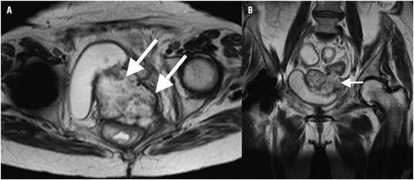 Resonancia magn&eacute;tica secuencia axial con informaci&oacute;n T2 (A) axial y (B)
coronal. Lesi&oacute;n p&eacute;lvica qu&iacute;stica multiloculada
(flechas blancas) de paredes y septos gruesos que compromete la pared del
recto, la c&uacute;pula vaginal y la pared posterior de la vejiga, que corresponde a
un caso de un paciente con recidiva tumoral.