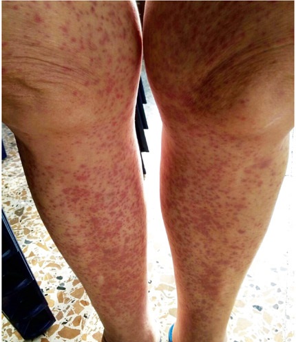 Lesiones tipo
p&uacute;rpura en miembros inferiores con diagn&oacute;stico histol&oacute;gico de vasculitis leucocitocl&aacute;stica